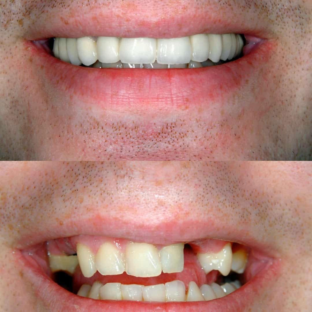 Before-and-After-Images-V2-1