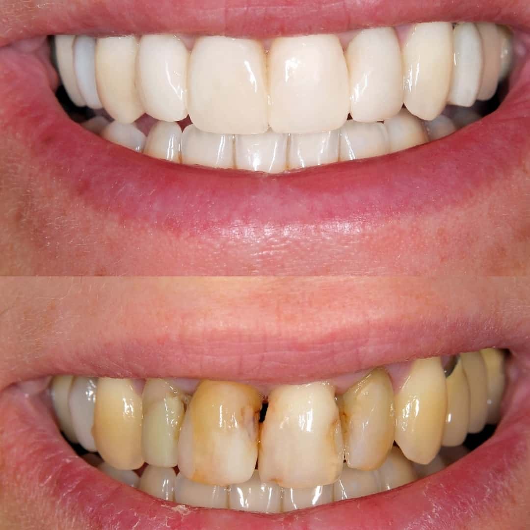 Before and After Images V3