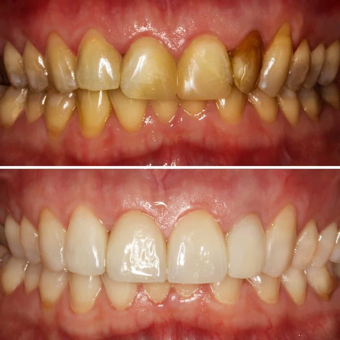 Before and After Images V4