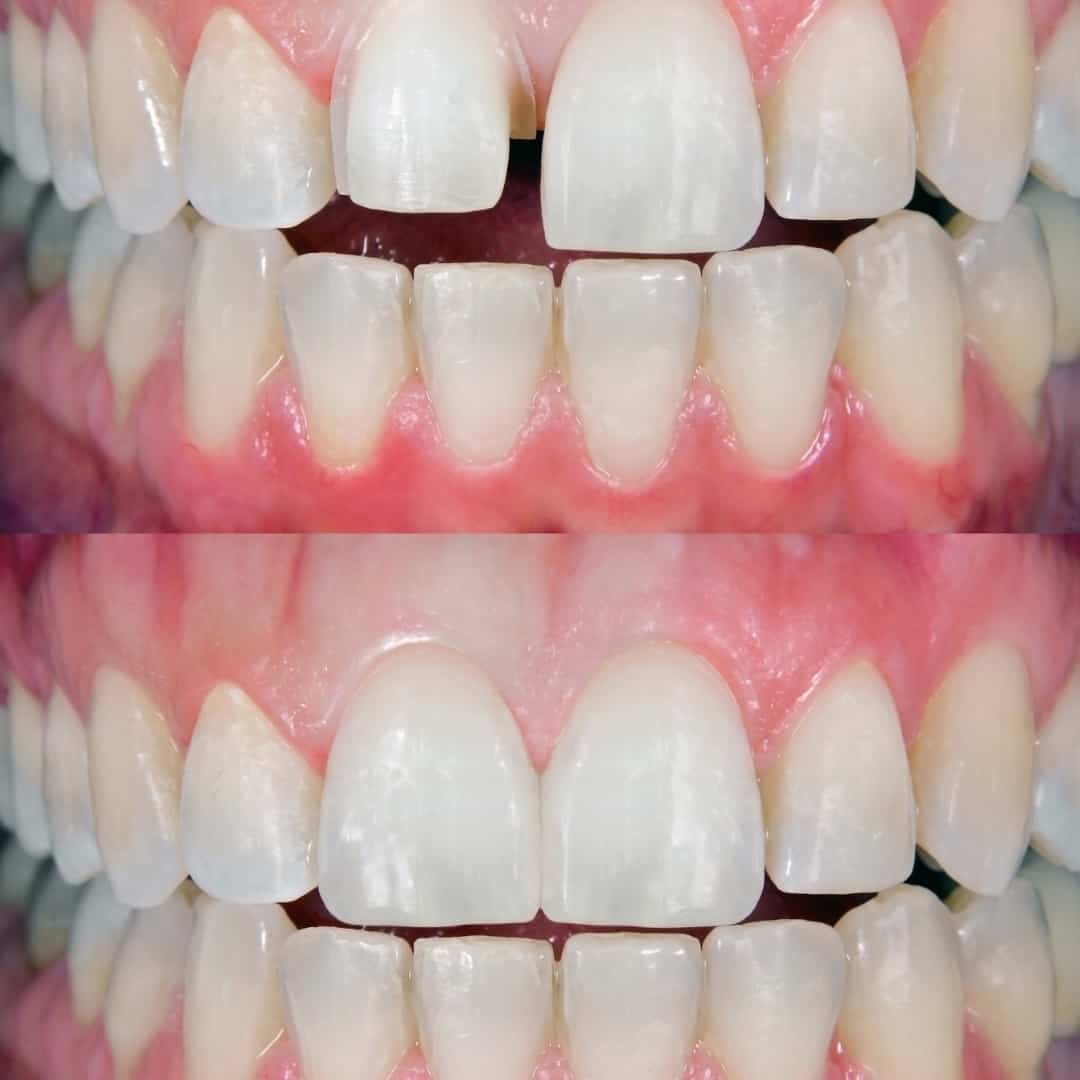 Before and After Images V5